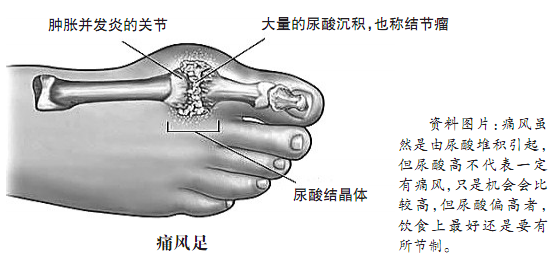 得了痛风虽然很多忌口但也不是什么都不能吃，看看专家怎么说！