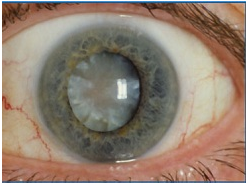 新加坡近八成年长者患白内障 是因为赤道紫外线太强？