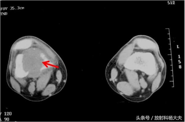 膝盖疼被乡里大夫诊断为关节炎，可到城里医院一检查，竟是这大病