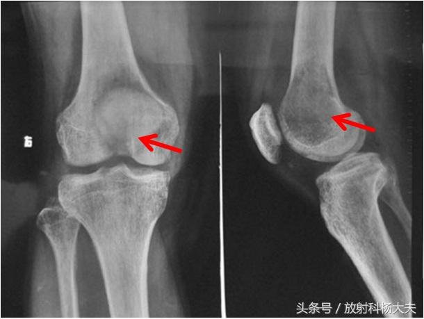 膝盖疼被乡里大夫诊断为关节炎，可到城里医院一检查，竟是这大病