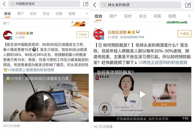 8090脱发严重！你的发际线还好吗？