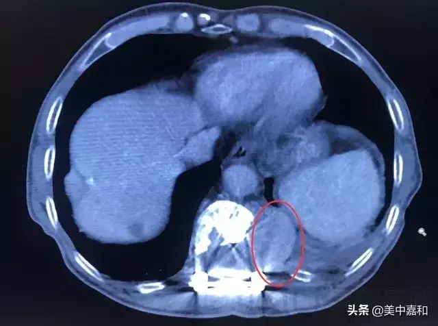 肿瘤患者腰背痛？不一定是劳损，也可能是癌症骨转移