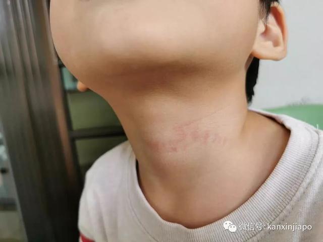 儿子身上多处瘀伤，母亲控诉新加坡幼儿园老师虐童