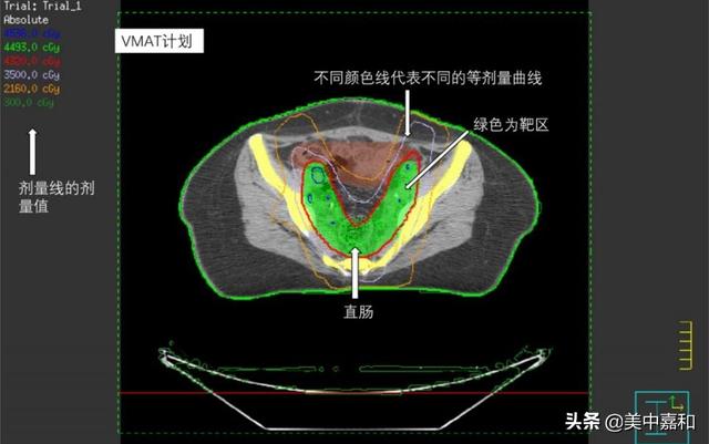 肿瘤中期变晚期，她还能实现保护卵巢的愿望吗？