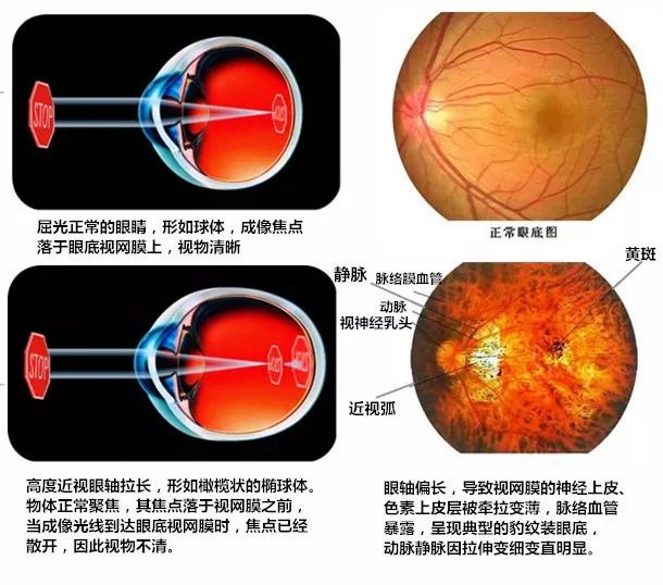 为什么近视低龄化越来越严重？已经得了近视，究竟该不该做手术？