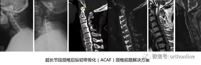 破颈椎前路手术禁忌，绘脊柱外科创新华章——国际视角下的ACAF