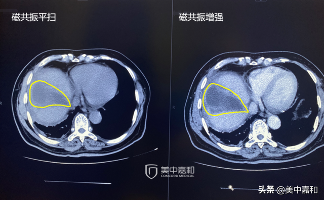 肿瘤破了，容易复发？是真的