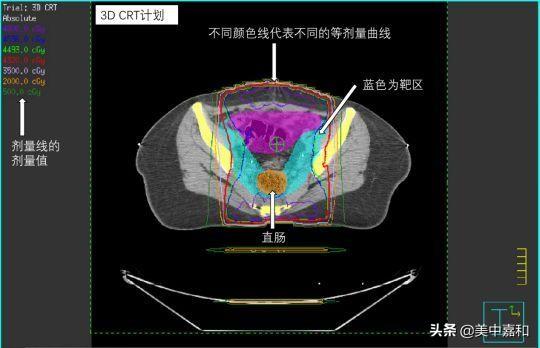 肿瘤中期变晚期，她还能实现保护卵巢的愿望吗？