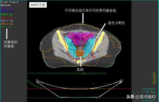 肿瘤中期变晚期，她还能实现保护卵巢的愿望吗？