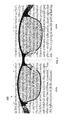 美国专利 治疗近视的眼镜