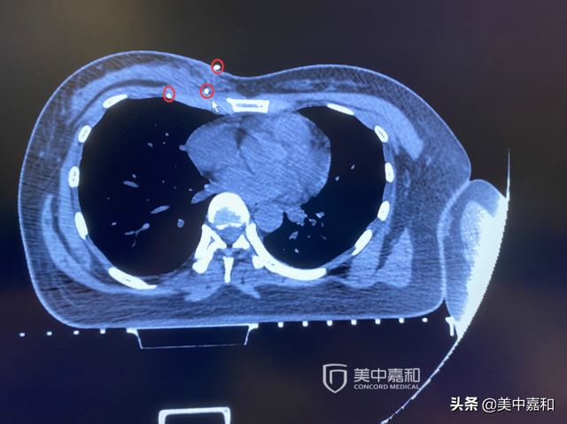 这样做，术后防复发，还能避免过度治疗