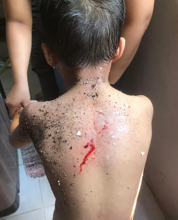 新加坡男孩住政府公房，洗澡时天花板竟塌了，后背被砸鲜血直流