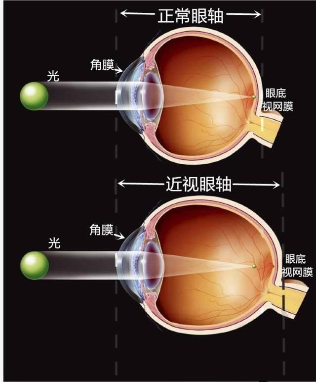 为什么近视低龄化越来越严重？已经得了近视，究竟该不该做手术？