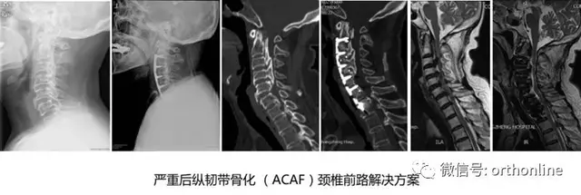 破颈椎前路手术禁忌，绘脊柱外科创新华章——国际视角下的ACAF