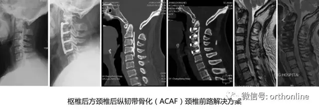 破颈椎前路手术禁忌，绘脊柱外科创新华章——国际视角下的ACAF