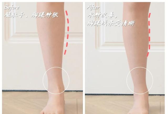 日本变态“腿部抽脂术”，7天小腿瘦3cm，堪比瘦腿针