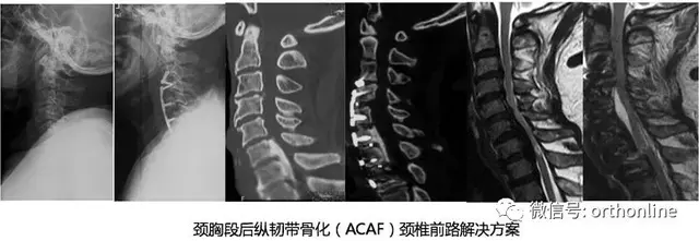 破颈椎前路手术禁忌，绘脊柱外科创新华章——国际视角下的ACAF