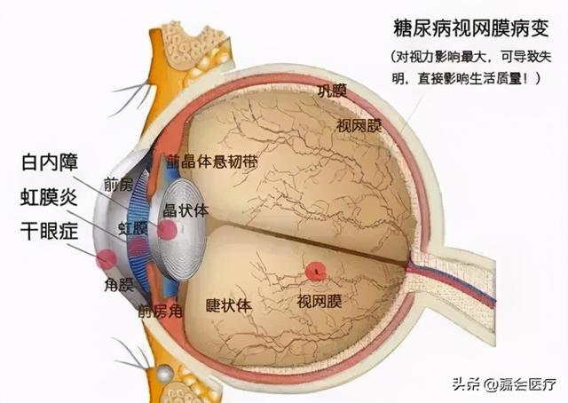 早期毫无症状，发现往往是晚期阶段，糖尿病眼病是怎么回事？