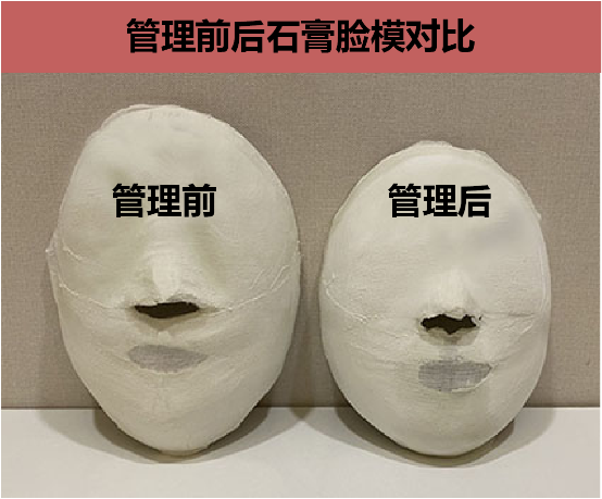 药手名家脸型矫正，用健康方法打造“小脸美人”