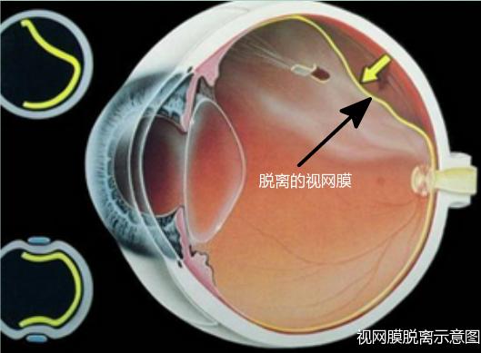 为什么近视低龄化越来越严重？已经得了近视，究竟该不该做手术？