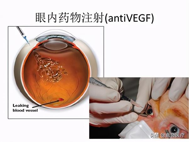 早期毫无症状，发现往往是晚期阶段，糖尿病眼病是怎么回事？