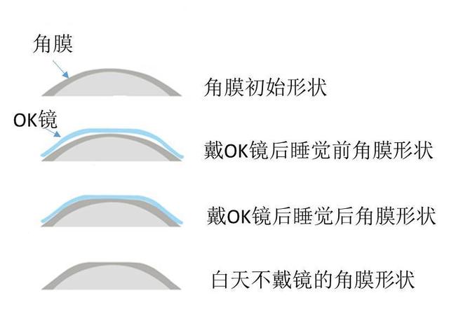 为什么近视低龄化越来越严重？已经得了近视，究竟该不该做手术？