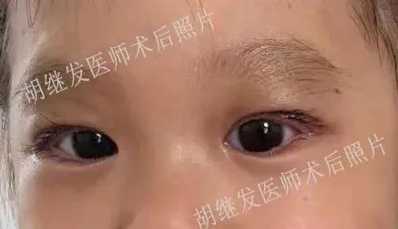 新加坡3岁小女孩眼皮一直睁不开，医生一招帮她“唤醒”