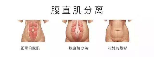 你还在错误使用产后绑腹带吗？