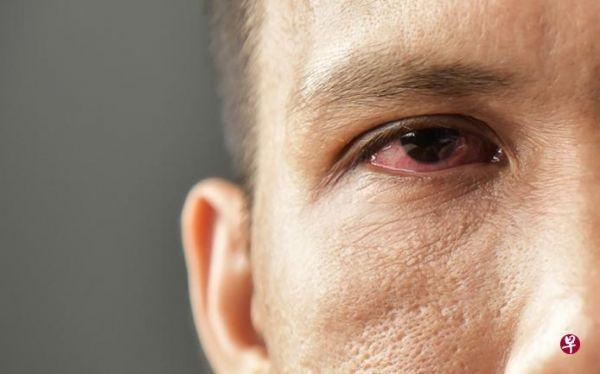 什么是青光眼？这种病可以治愈么？外媒这样说——