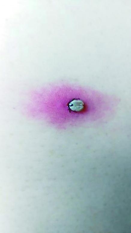 夏季蚊虫出没，除了“夺命蜱虫”，这些“恐怖生物”也要防着点