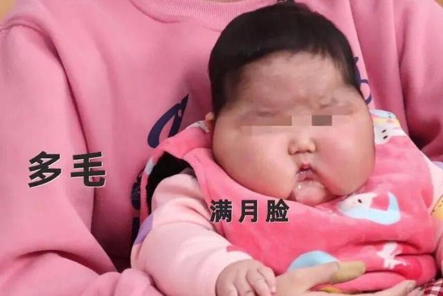 太吓人！新加坡5款保健品造成“月亮脸”，被紧急下架