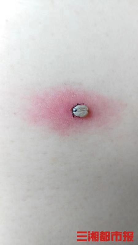 震惊！“夺命蜱虫”在9岁女孩头上吸血月余，妈妈以为是颗痣