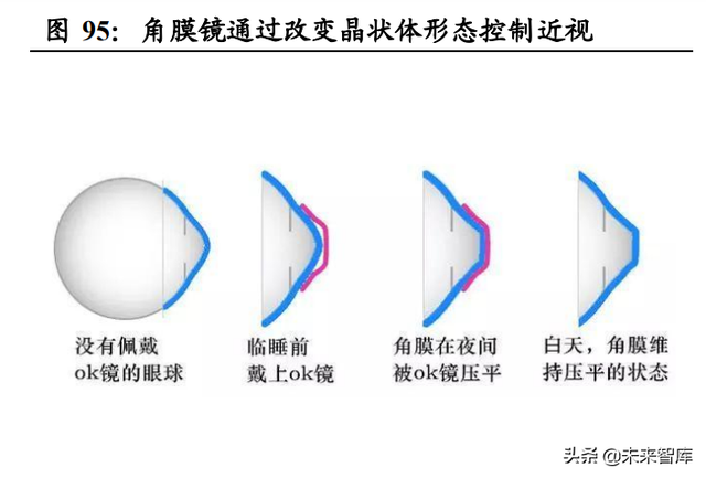 眼镜行业深度报告：眼镜市场千亿规模，近视防控赛道加速崛起